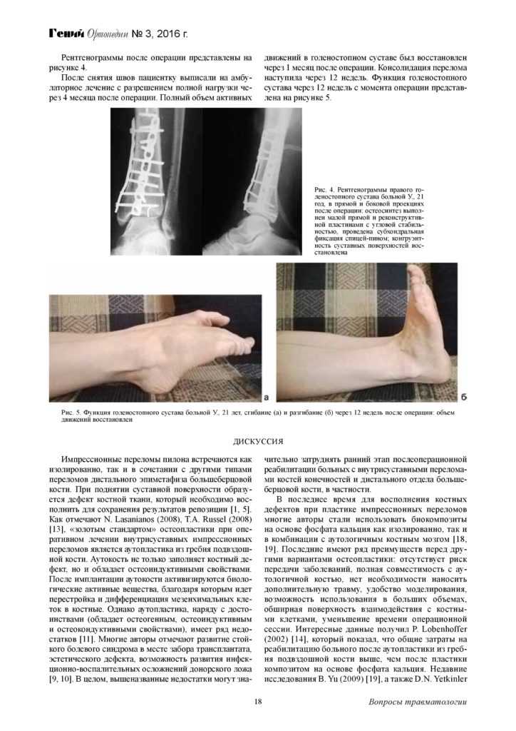 augmentaciya-kostnyx-defektov-distalnogo-otdela-page-4